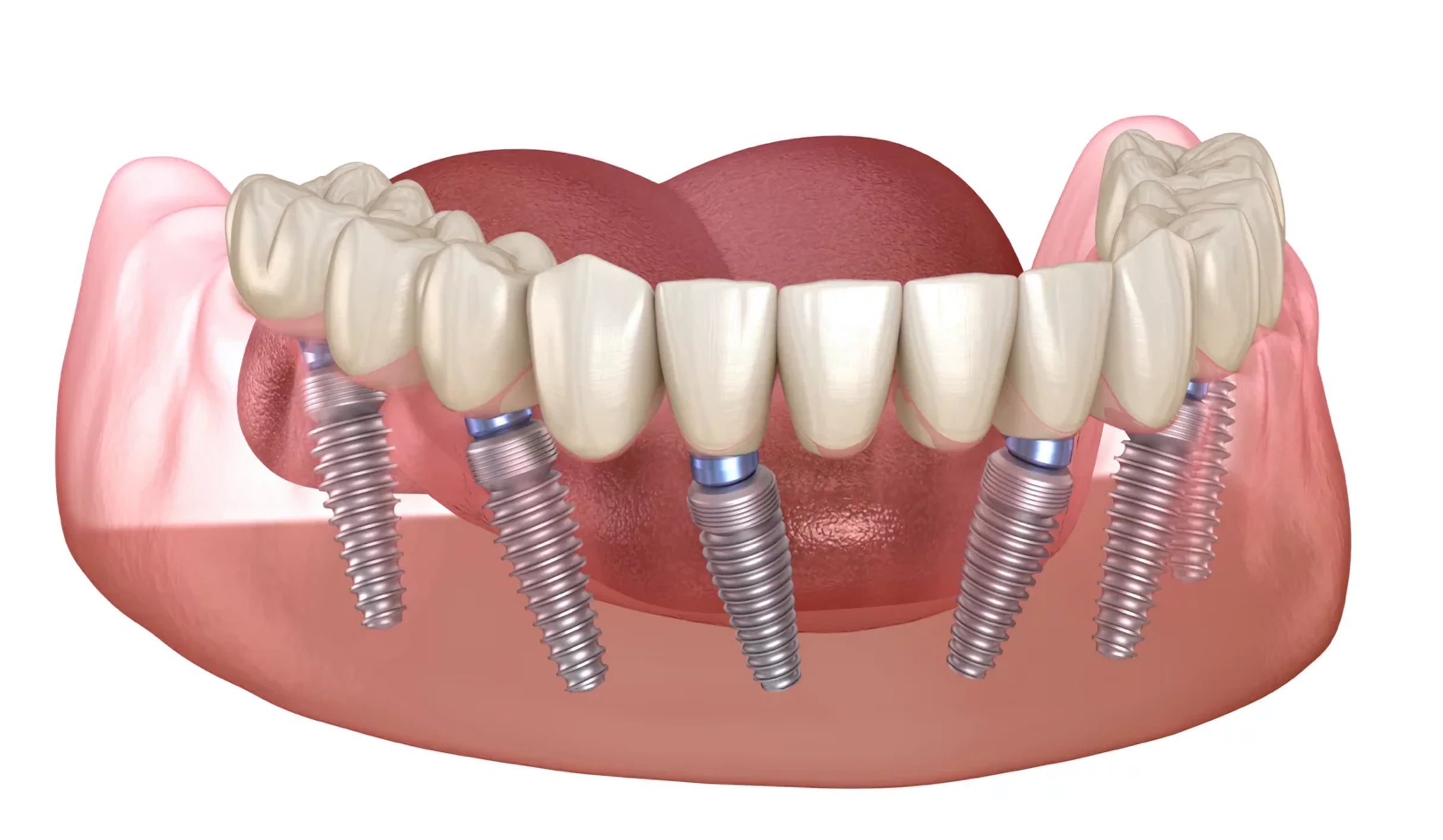 Implantacja zębów All-on-6 w Turcji