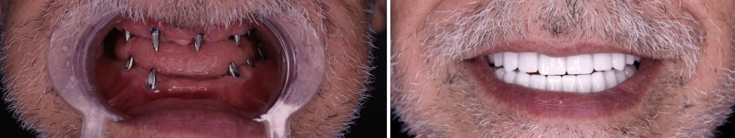 Implantacja zębów All-on-6 w Turcji przed i po
