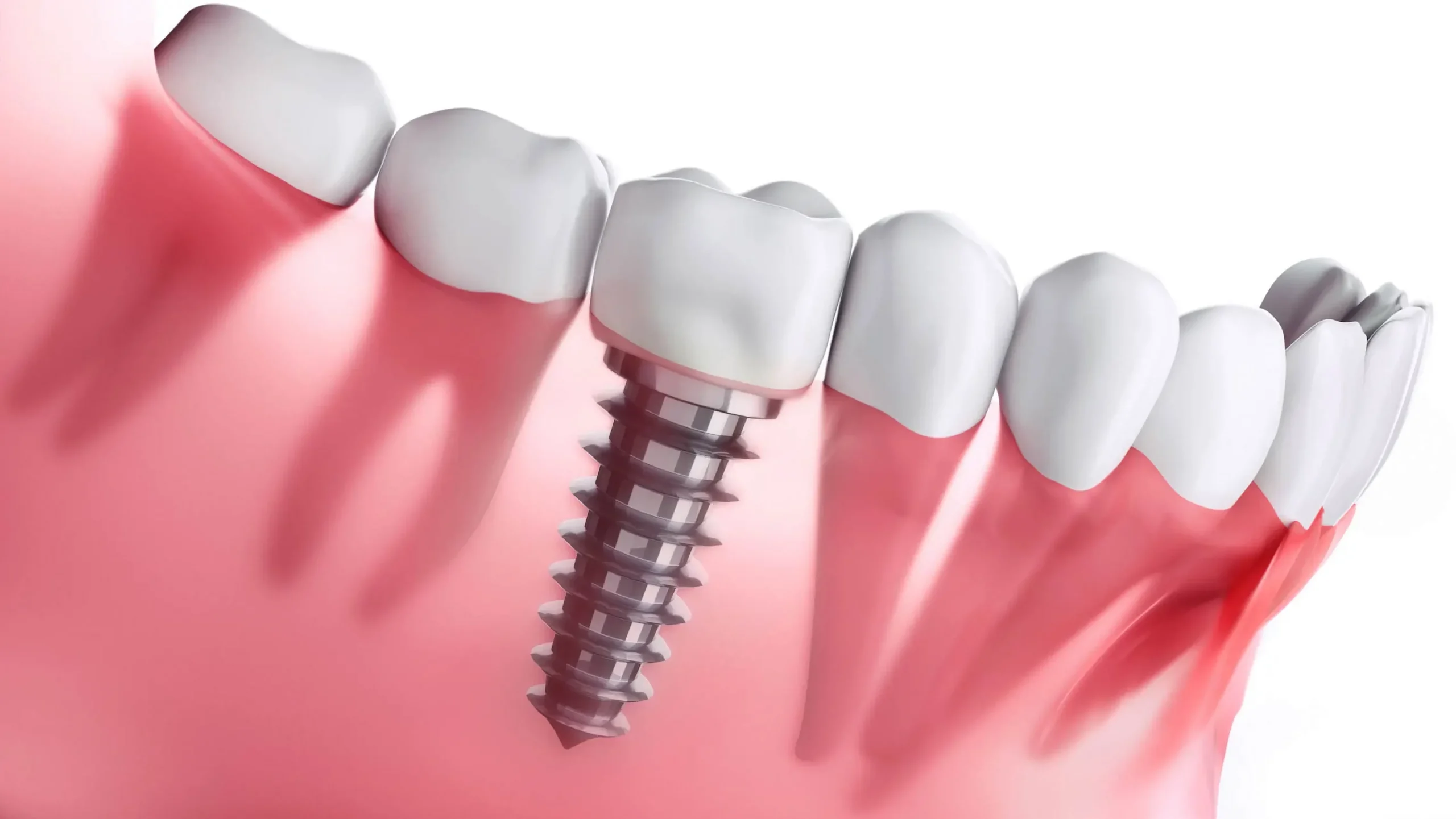 Instalacja implantów zębowych w Turcji