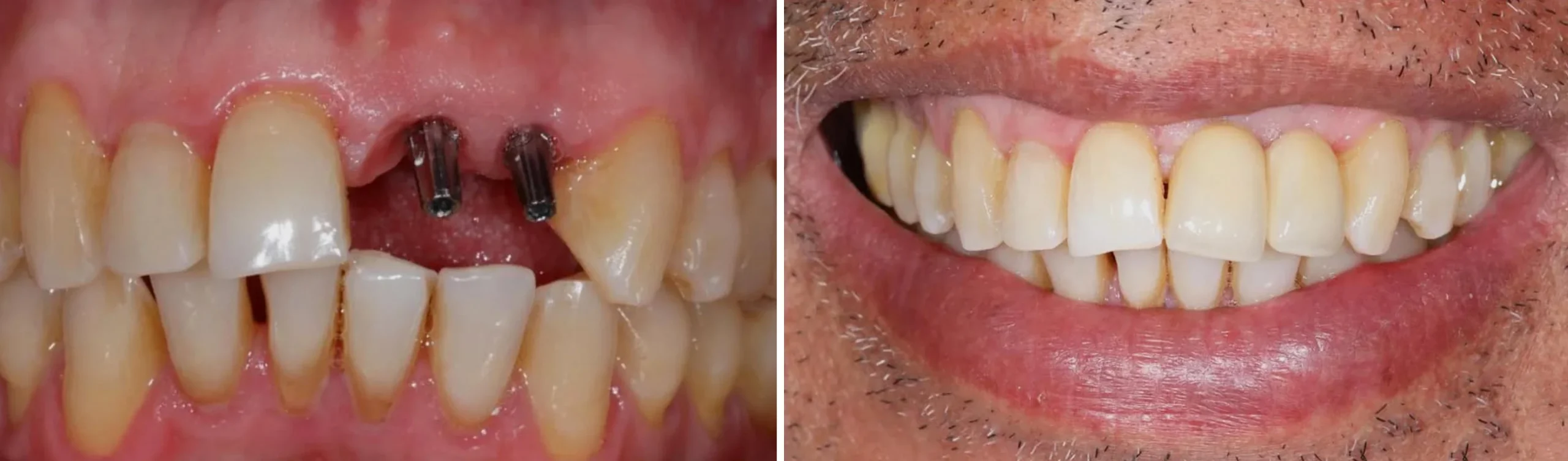 Instalacja implantu zębowego w Turcji — przed i po