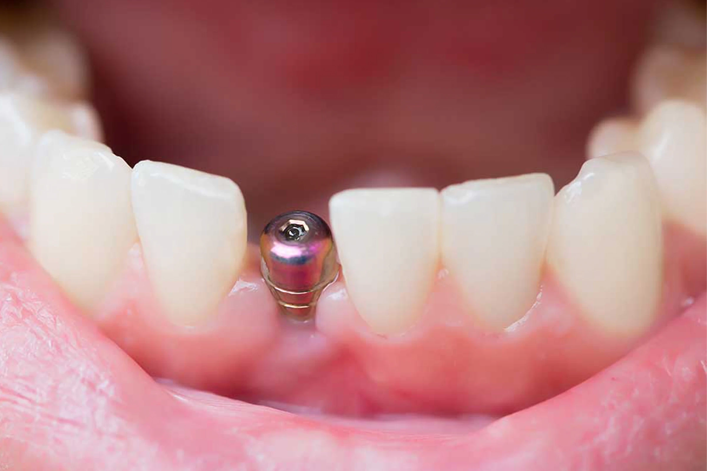 Proces instalacji implantu zębowego w Turcji