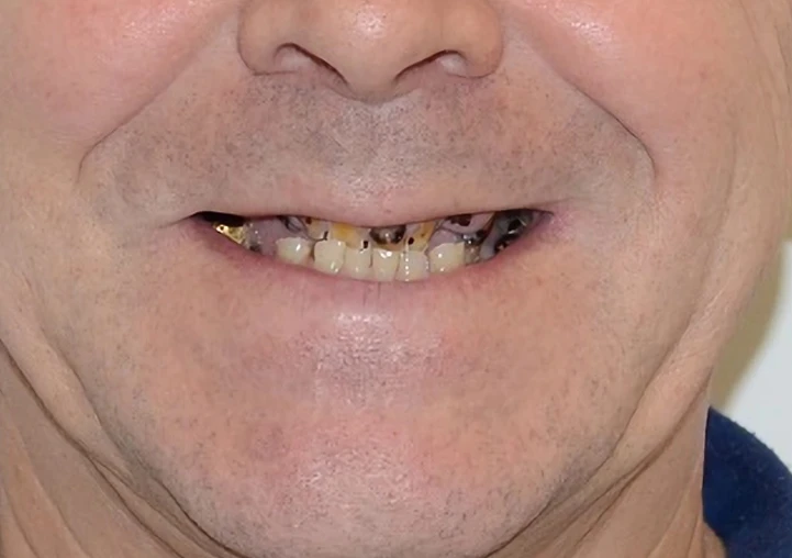 Przed zabiegiem