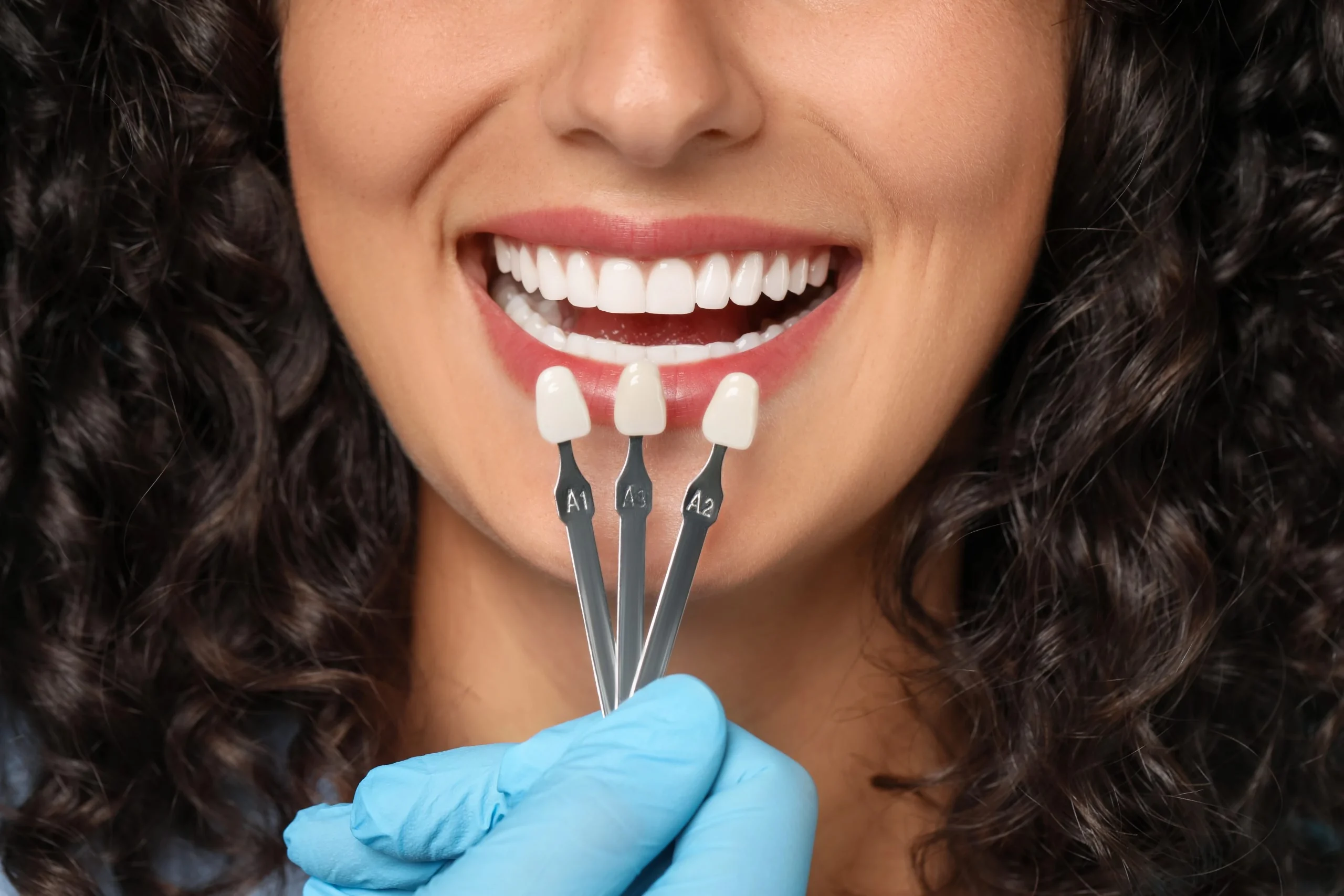 Zakładanie licówek w Turcji w ramach Hollywood Smile