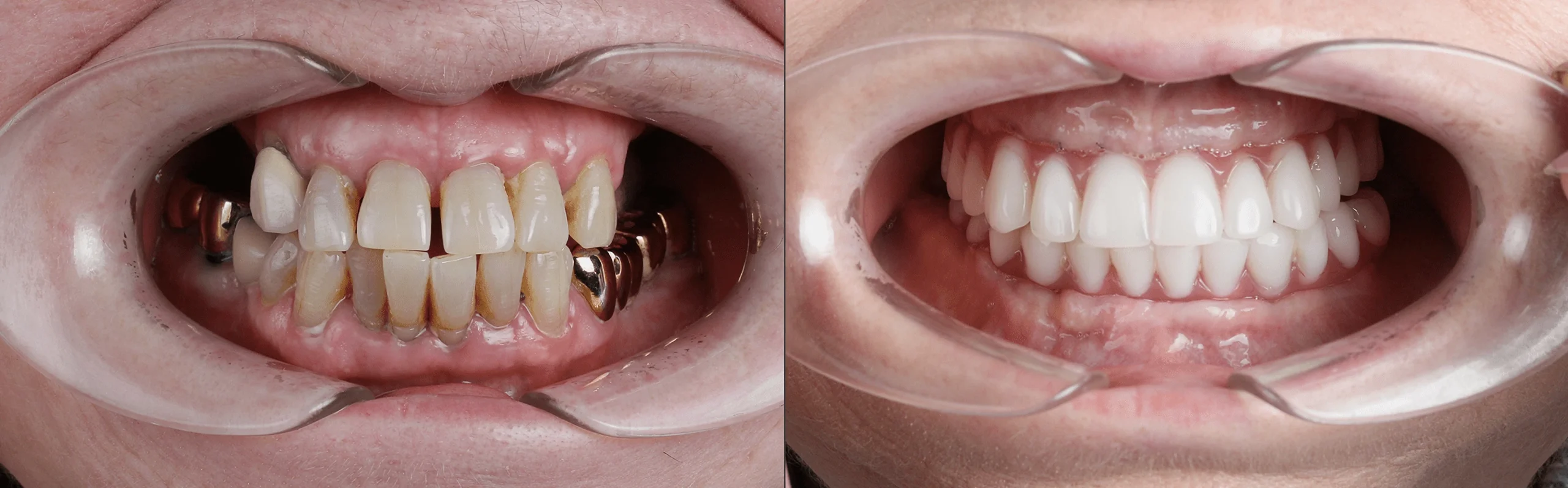 Zdjęcie przed i po implantacji All-on-4 w Turcji