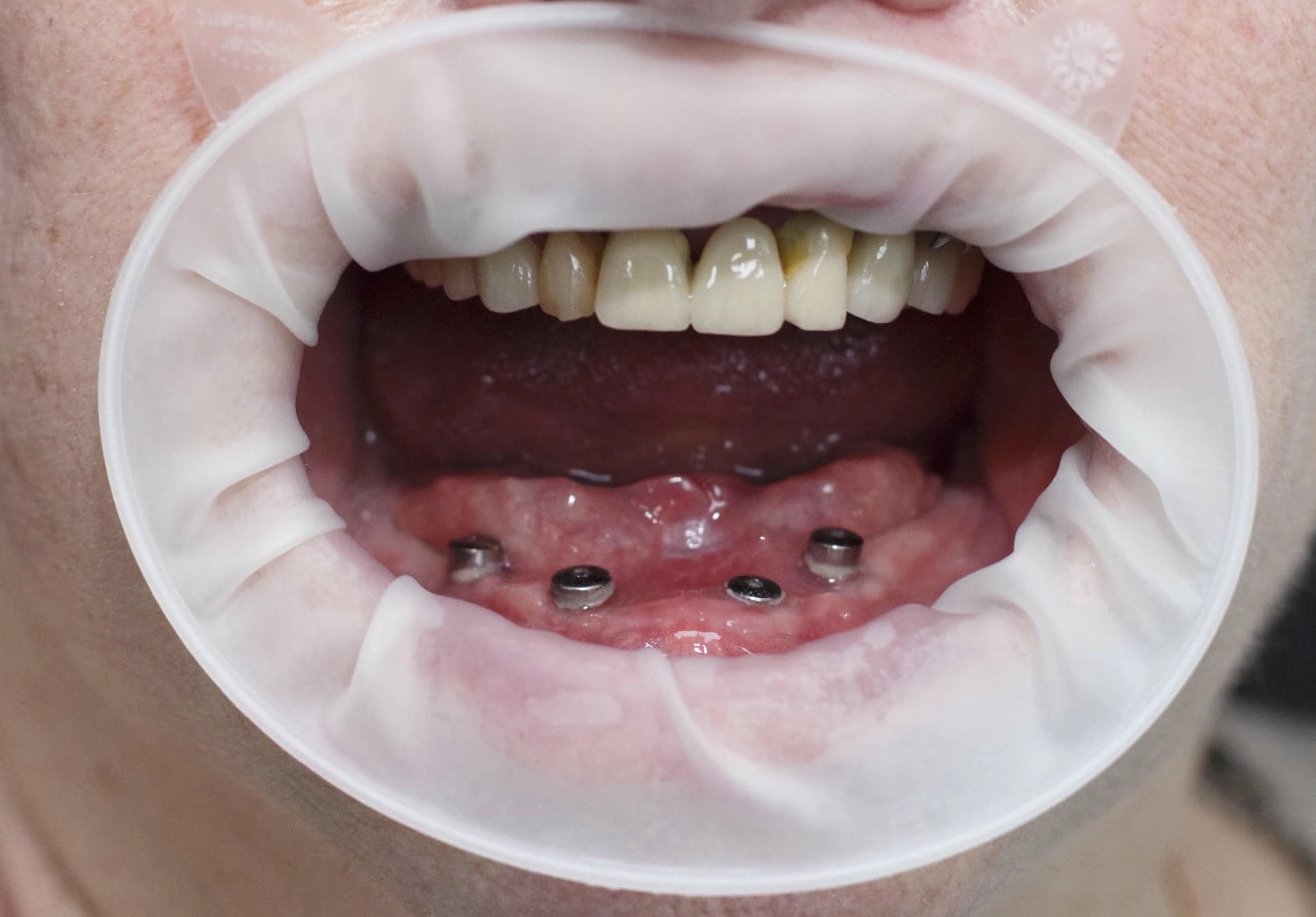 Jak przebiega implantacja zębów All-on-4 w Turcji