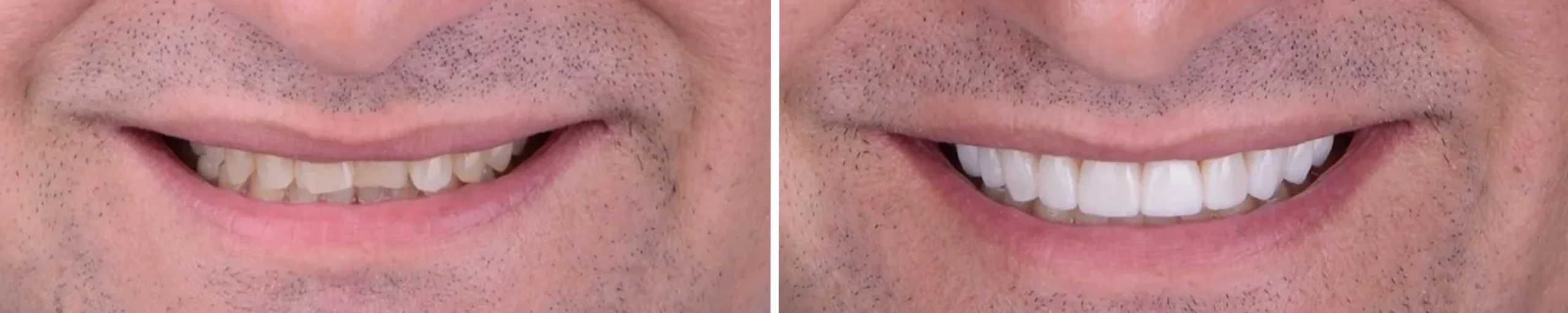 Rezultat instalacji implantów dentystycznych w Turcji przed i po